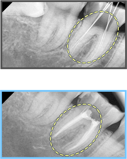 심미보철 증례05