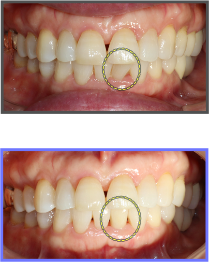 심미치료 증례01