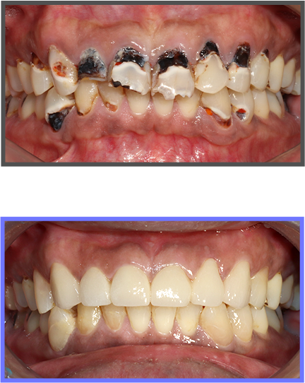 심미치료 증례02