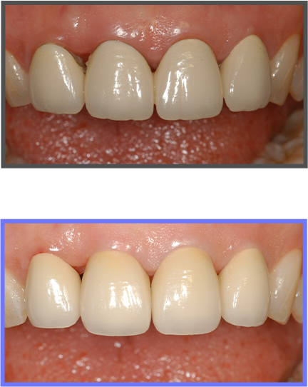 심미치료 증례04