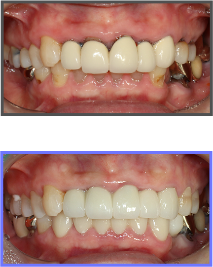 심미치료 증례04