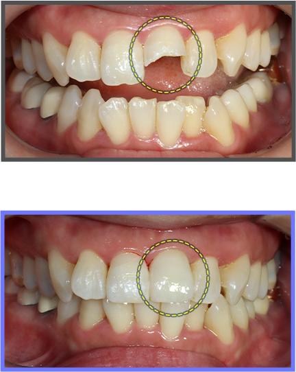 심미치료 증례05