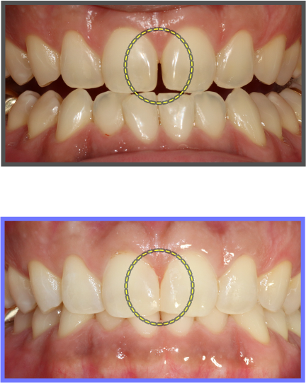 심미치료 증례06