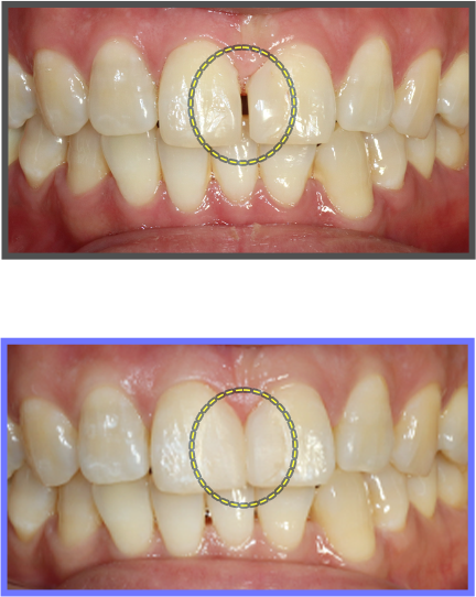 심미치료 증례07