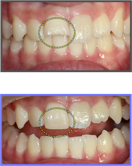 심미치료 증례08