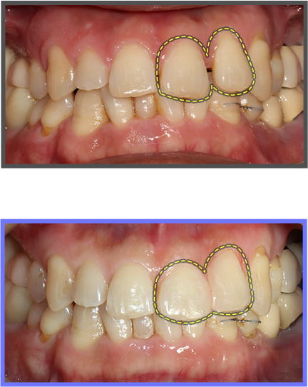 심미치료 증례09