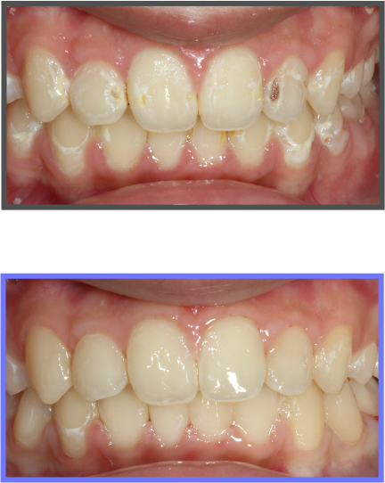 심미치료 증례10