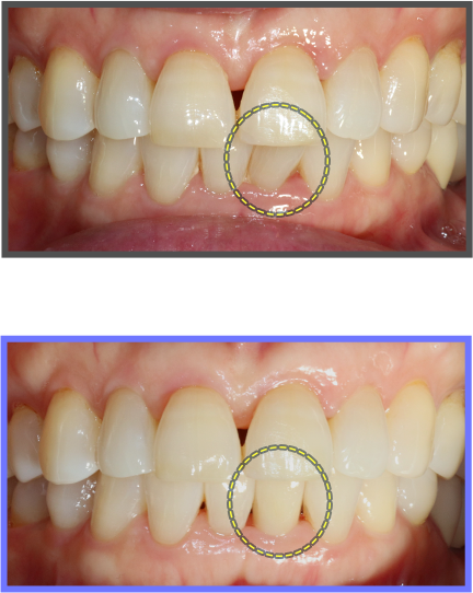 심미치료 증례11