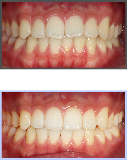 투명교정 증례01