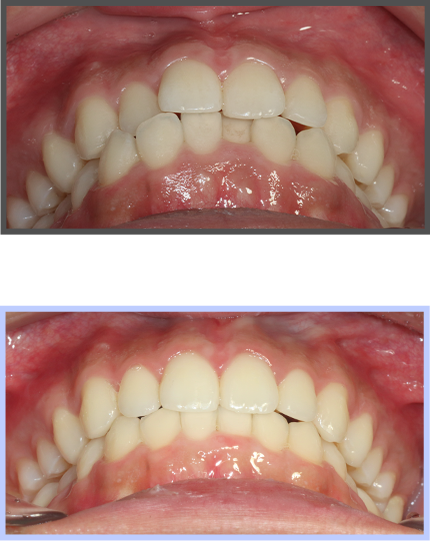 투명교정 증례02