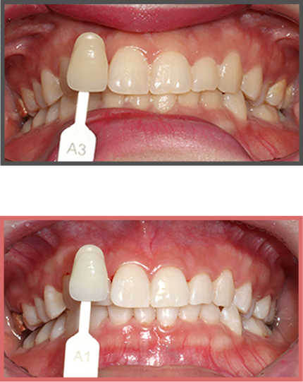 치아미백 증례07