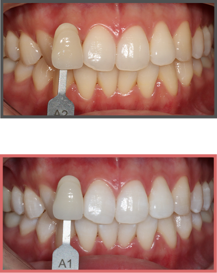치아미백 증례08