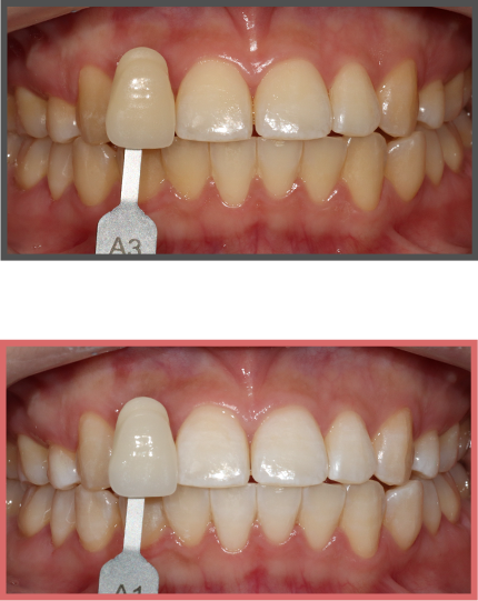 치아미백 증례09