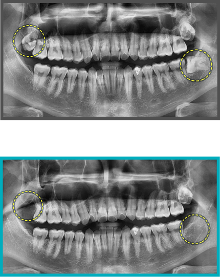 사랑니 발치 증례01