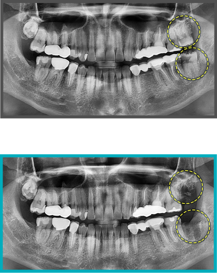 사랑니 발치 증례03
