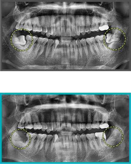 사랑니 발치 증례04