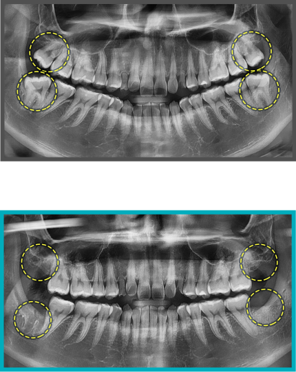 사랑니 발치 증례05