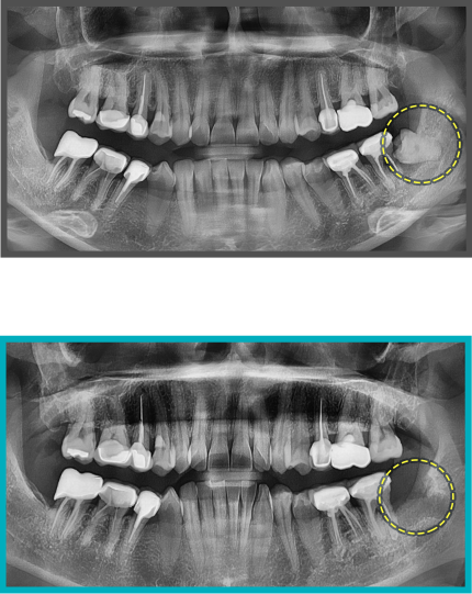 사랑니 발치 증례06