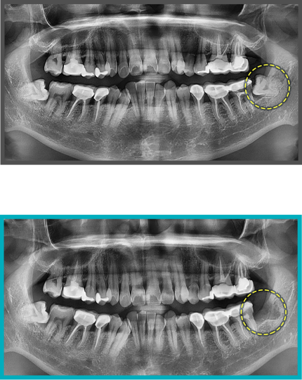 사랑니 발치 증례07