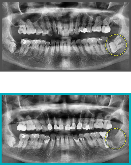 사랑니 발치 증례08