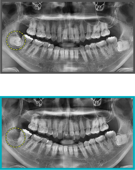 사랑니 발치 증례09