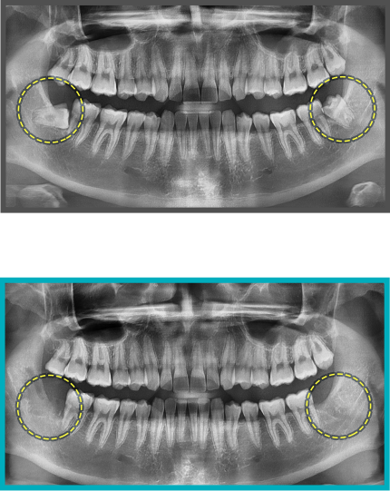 사랑니 발치 증례10