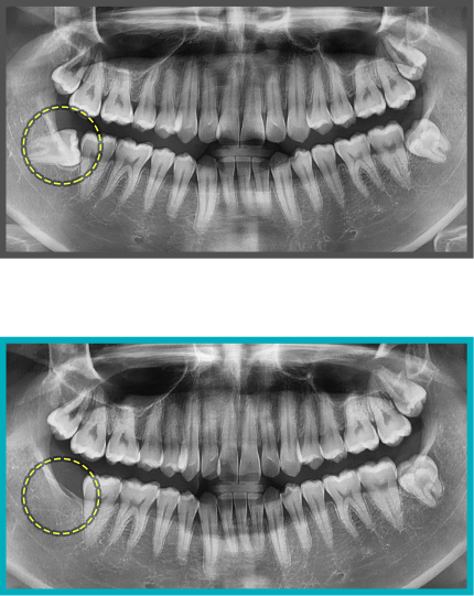 사랑니 발치 증례11