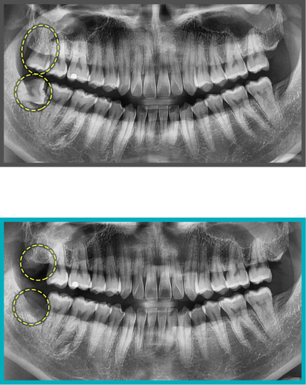 사랑니 발치 증례12