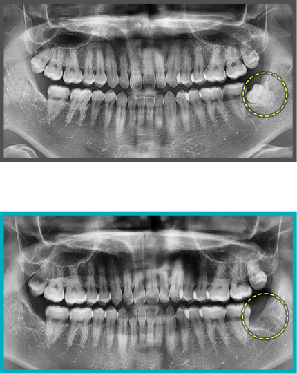 사랑니 발치 증례13