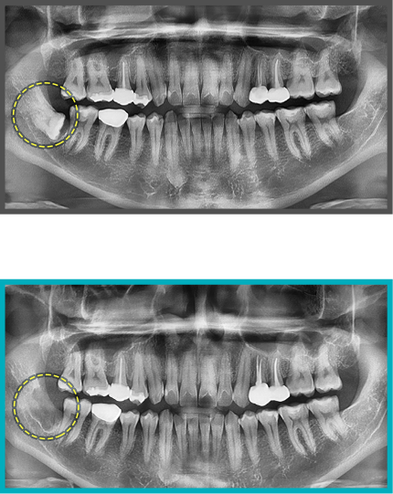 사랑니 발치 증례14