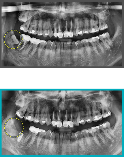 사랑니 발치 증례15
