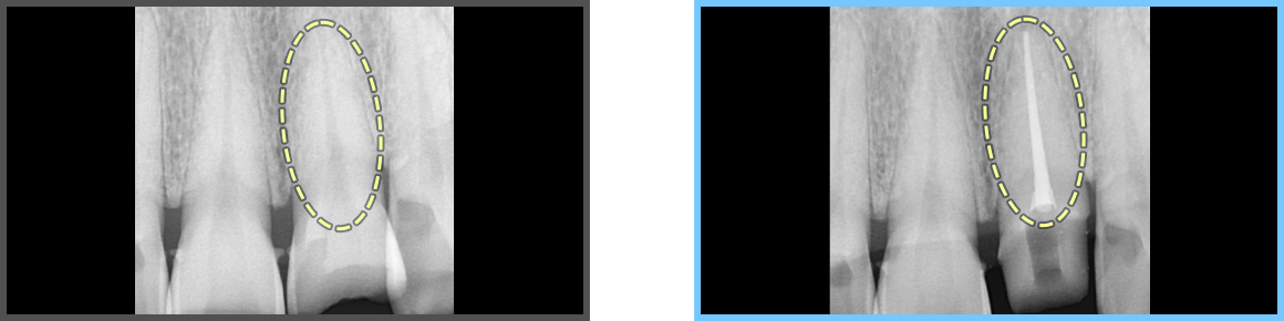 심미보철 증례01