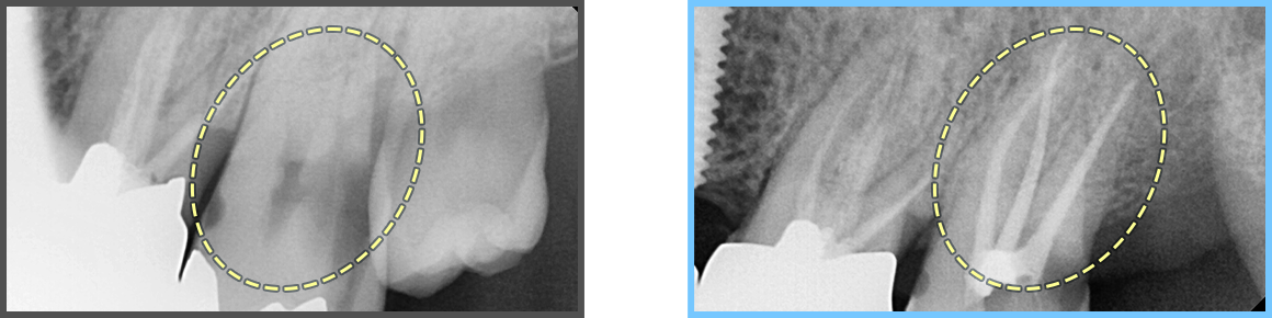심미보철 증례02