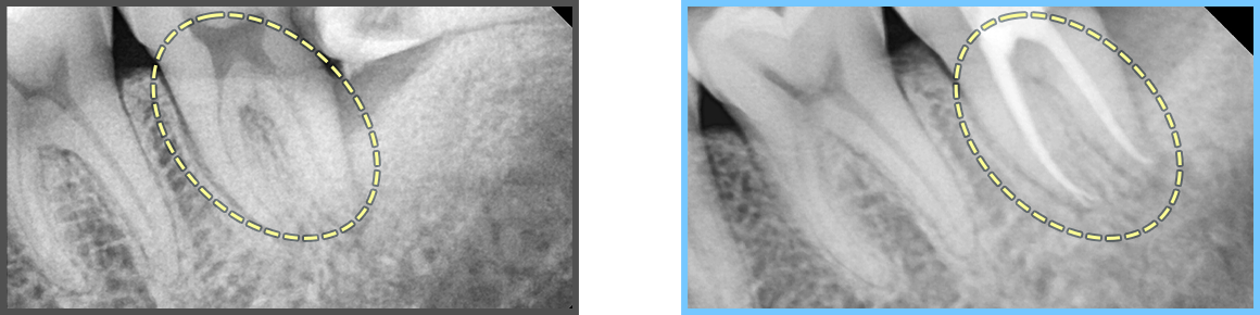 심미보철 증례04