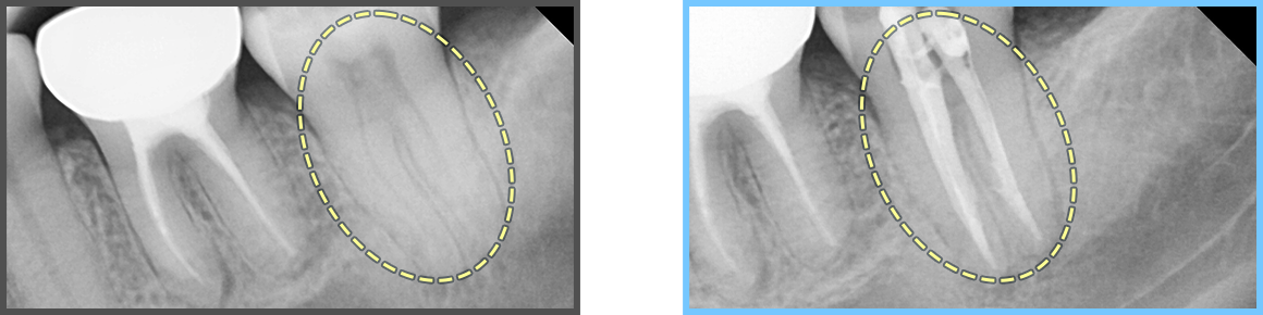 심미보철 증례04