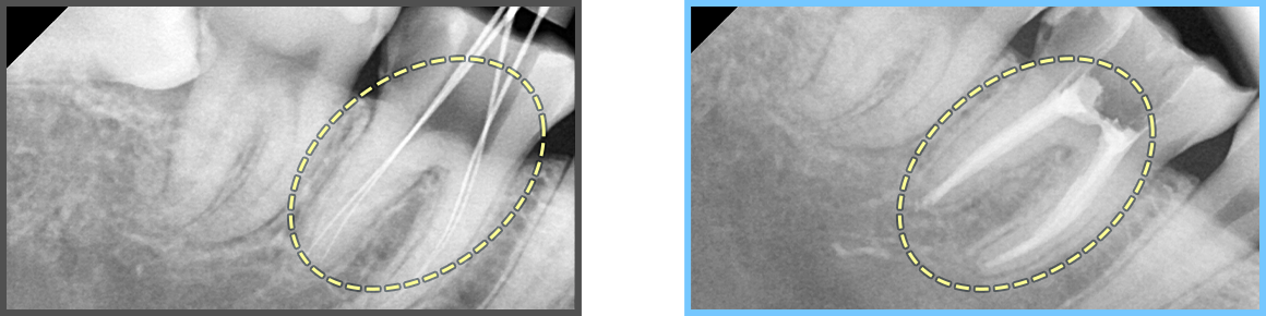 심미보철 증례05