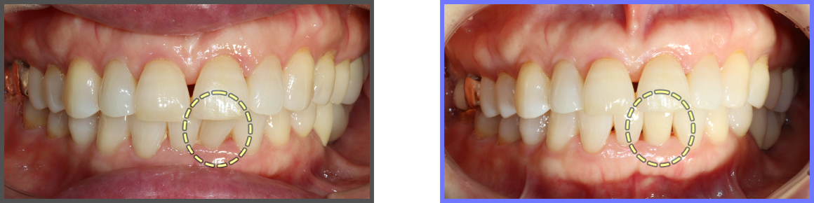 심미치료 증례01