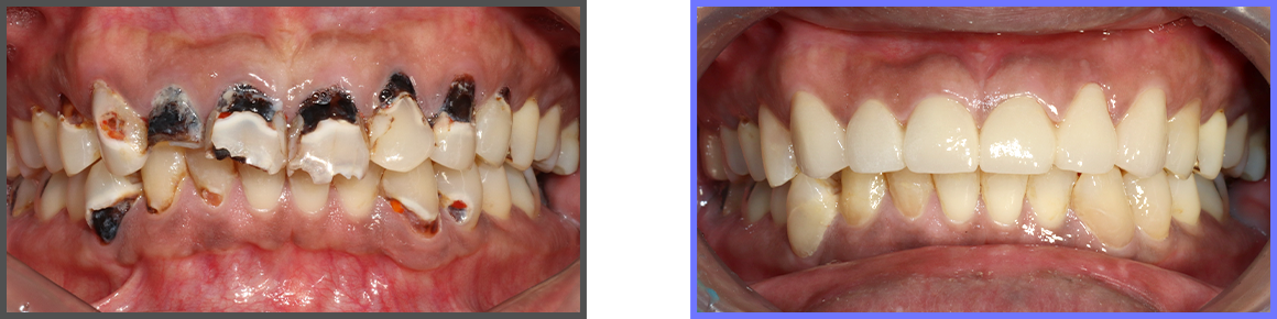 심미치료 증례02