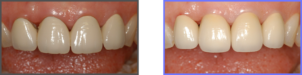 심미치료 증례04