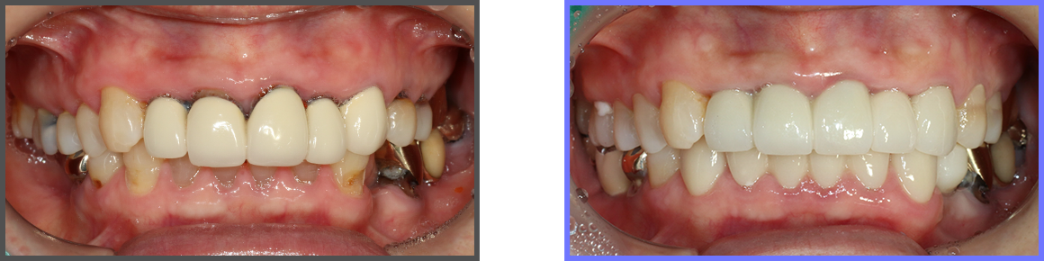 심미치료 증례04