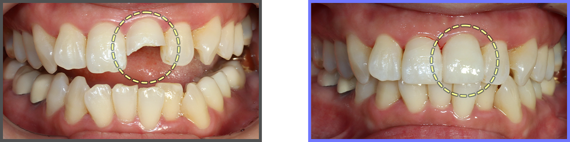 심미치료 증례05