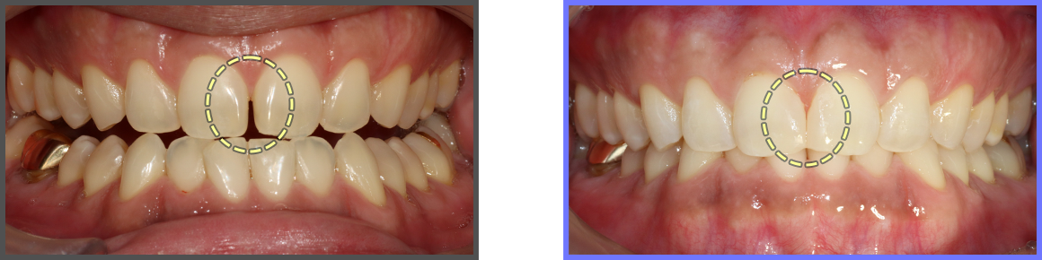 심미치료 증례06