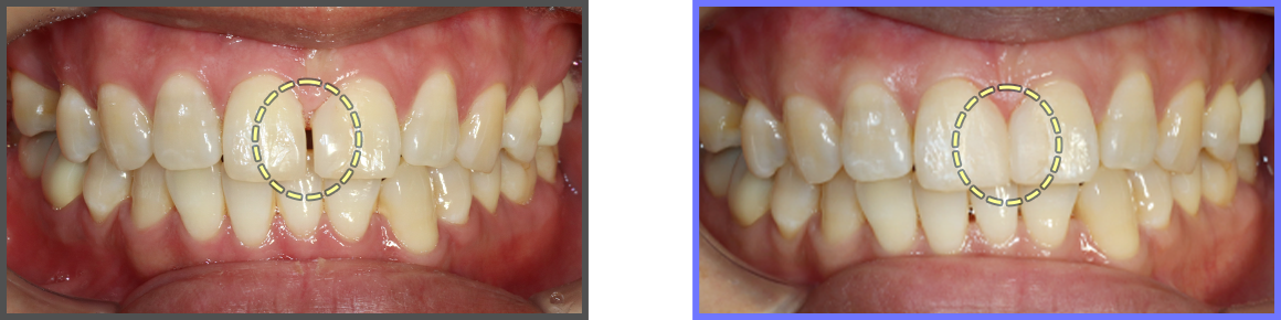 심미치료 증례07