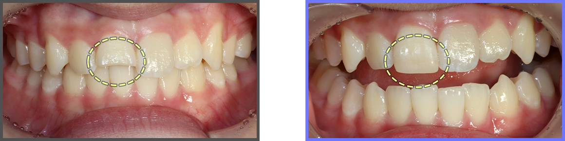 심미치료 증례08