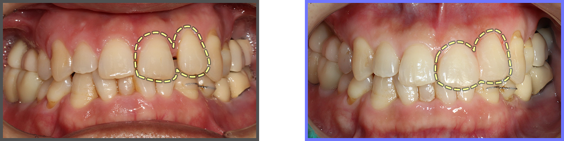 심미치료 증례09