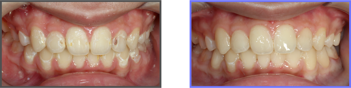 심미치료 증례10