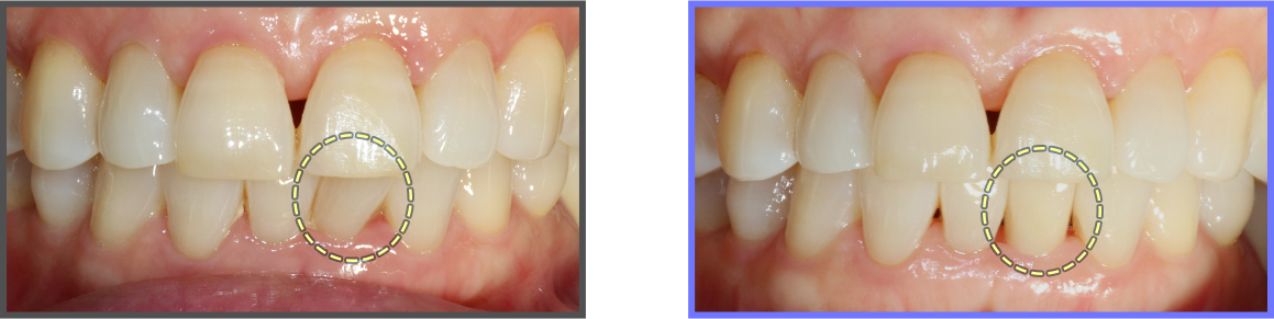 심미치료 증례11