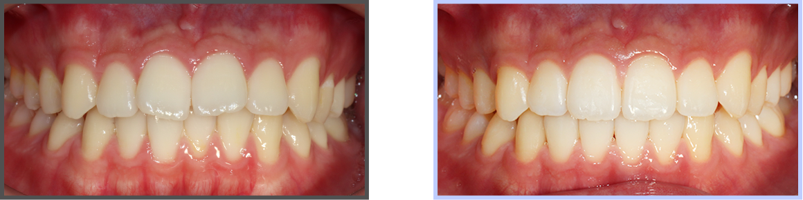 투명교정 증례01