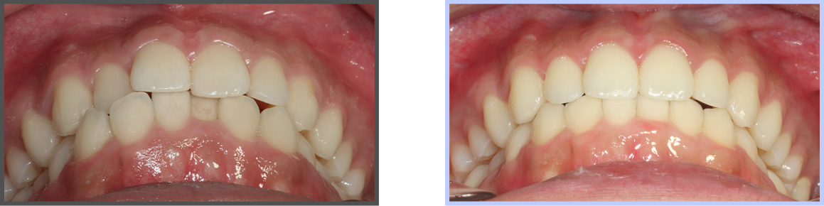투명교정 증례02