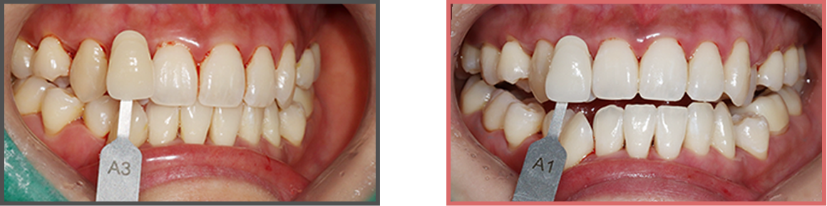 치아미백 증례04